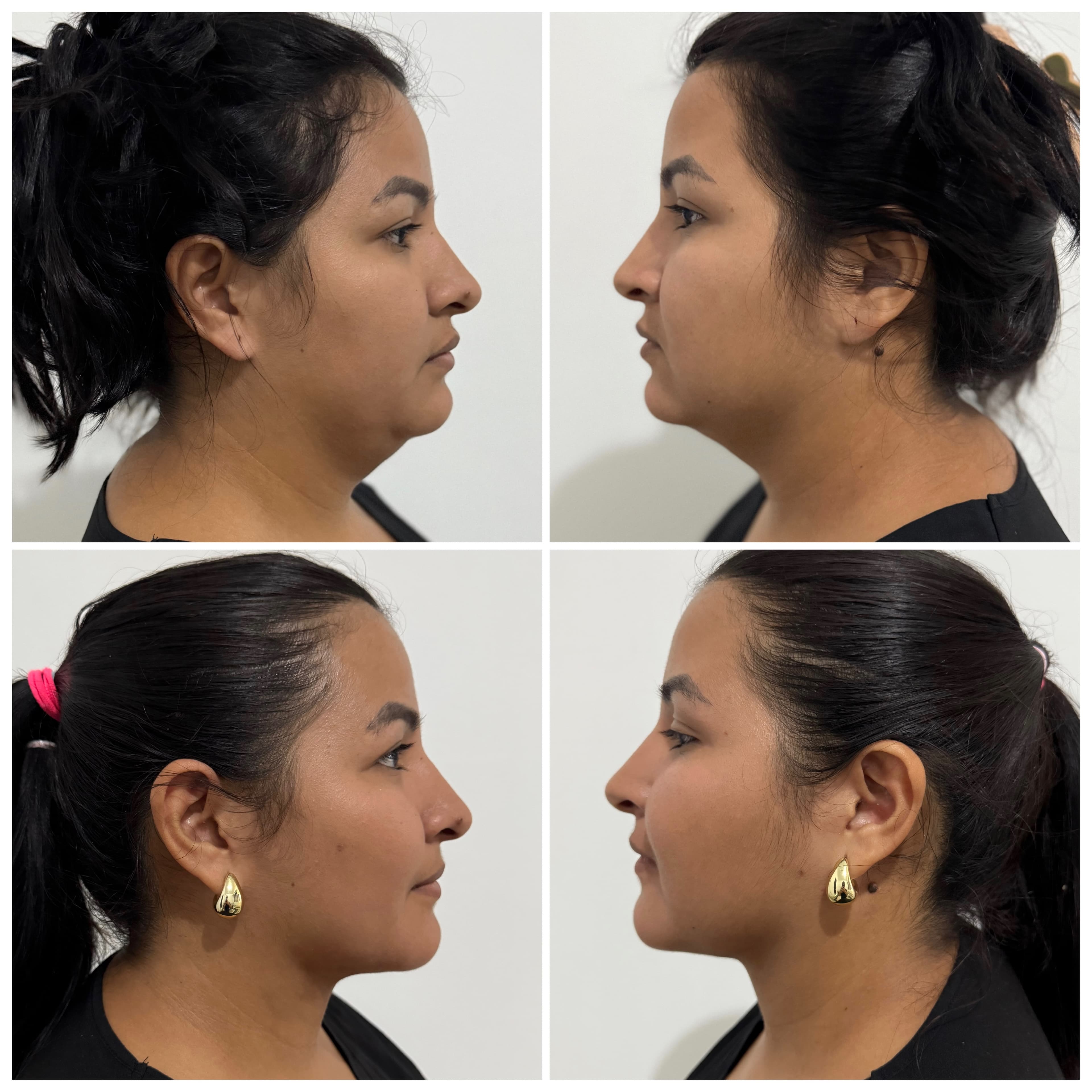 Lipopapada antes y después