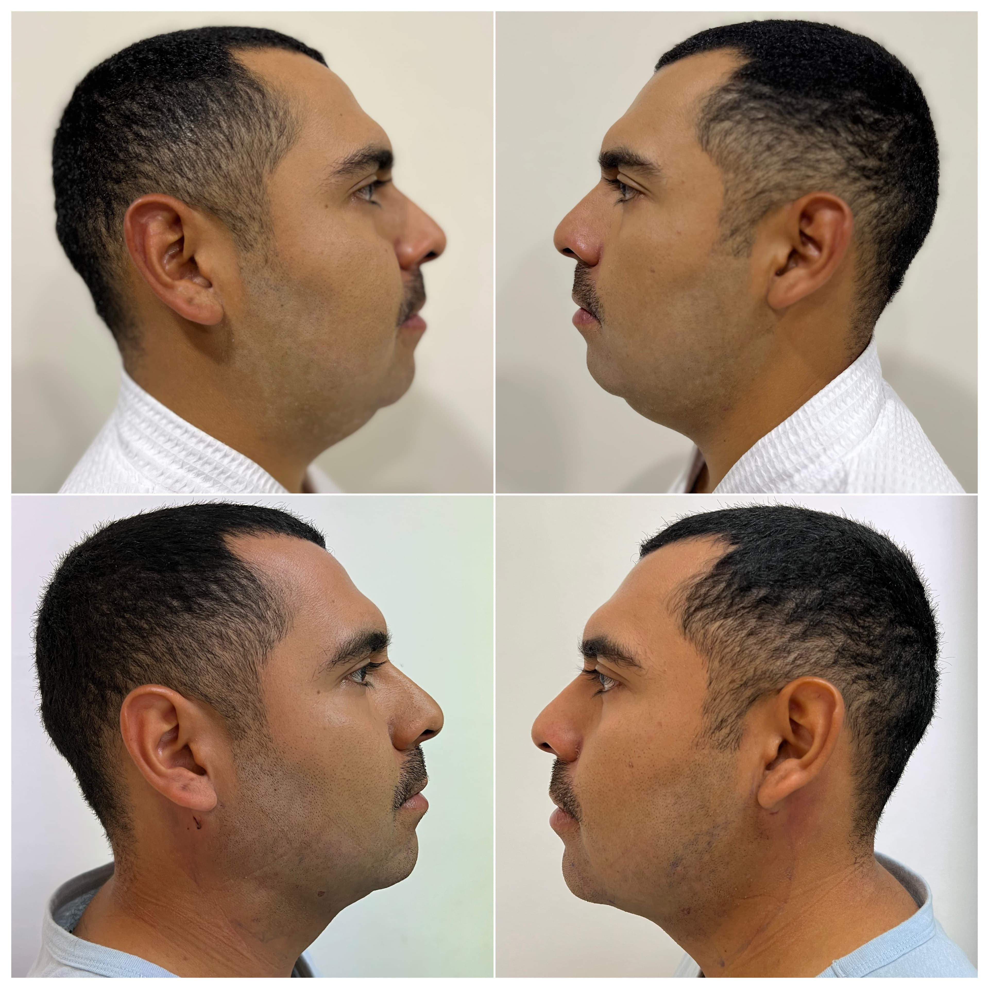 Lipopapada antes y después